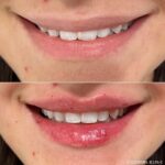 Lip Augmentation